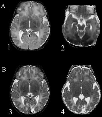 Neonatal Hypoglycemia and Brain Vulnerability